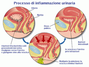 sintomi della cistite