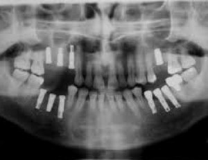 cisti dentale e mandibolare