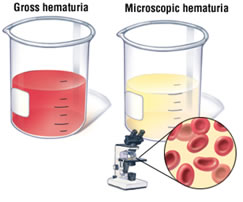 Ematuria-quando-nelle-urine-è-presente-del-sangue
