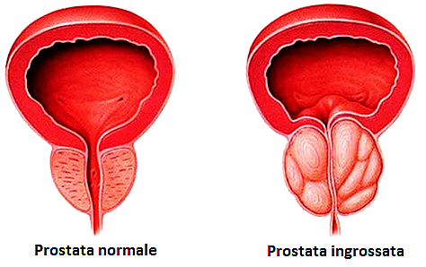 Ipertrofia-prostatica-causa-di-cistite-nell'uomo