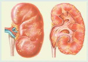 Nefrite-e-pielonefrite-nelle-alte-vie-urinariev